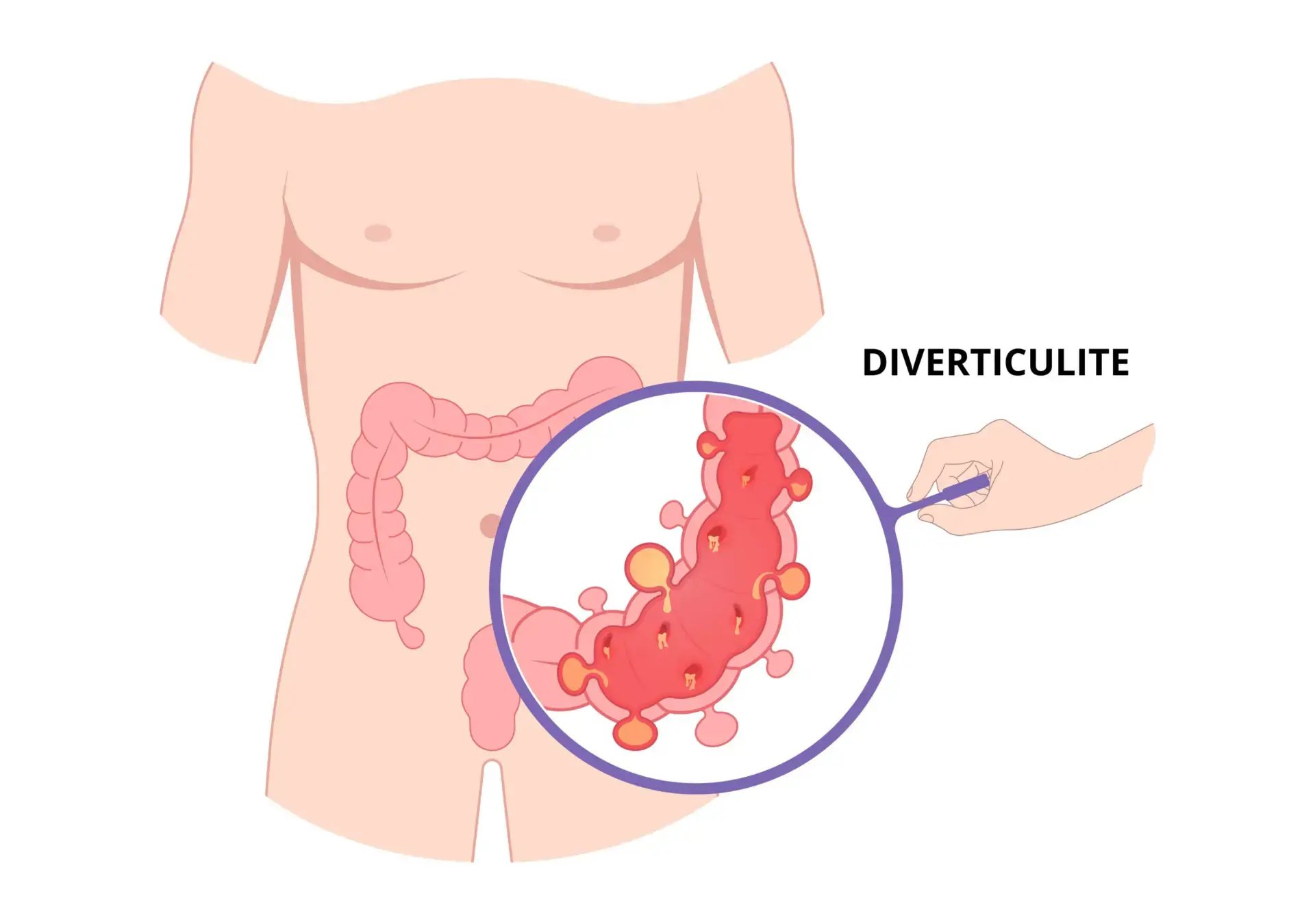 Diverticulite