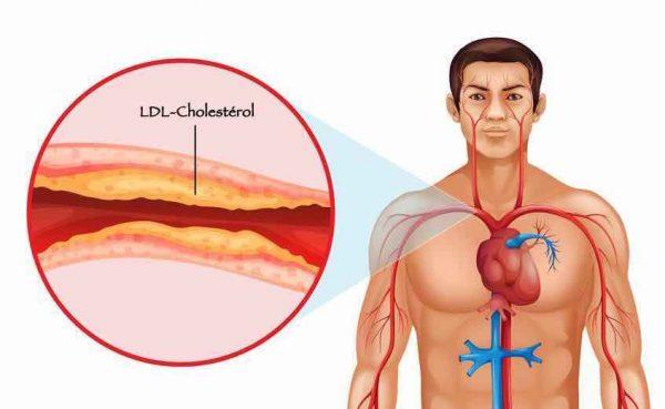 Cholesterol